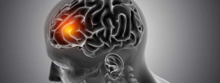 What is the Most Common Cause of Acute Stroke?