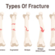 Different Types of Bone Fractures
